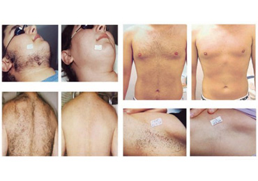 Diode Laser Hair Removal Treatment – Perfect Point