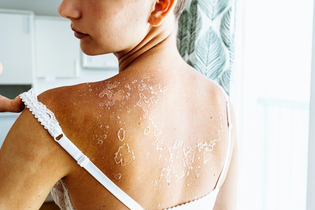 dry flaky skin on back of teenage girl