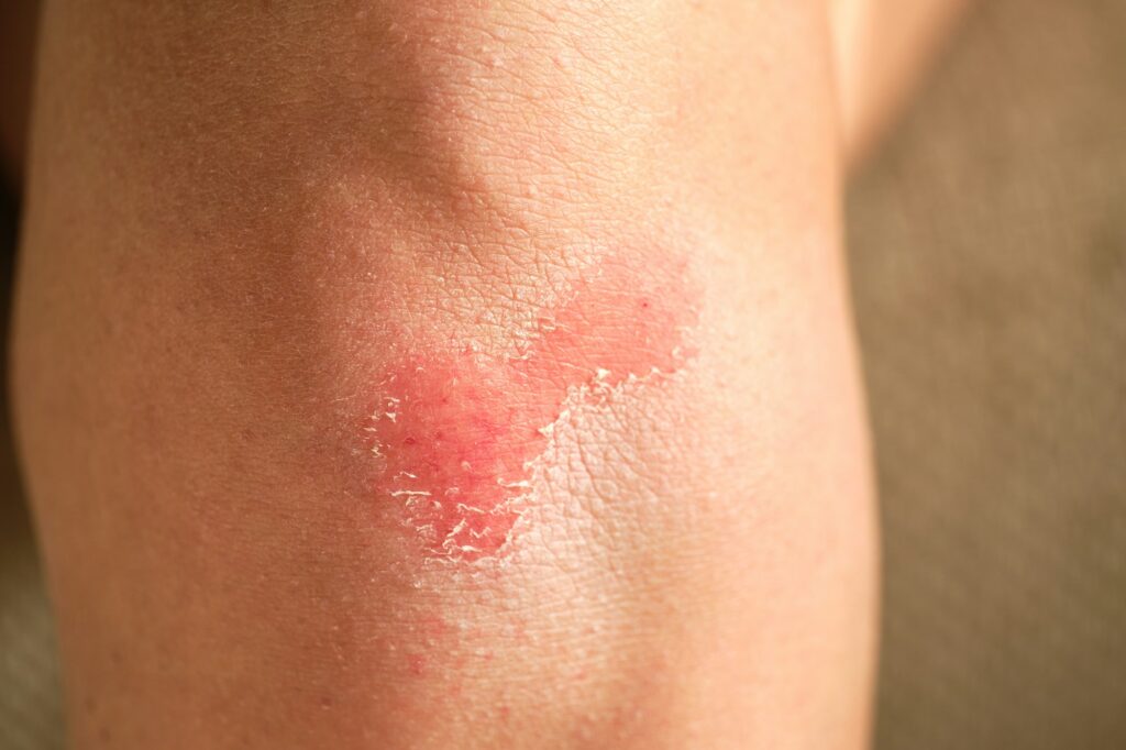 red wound on the knee