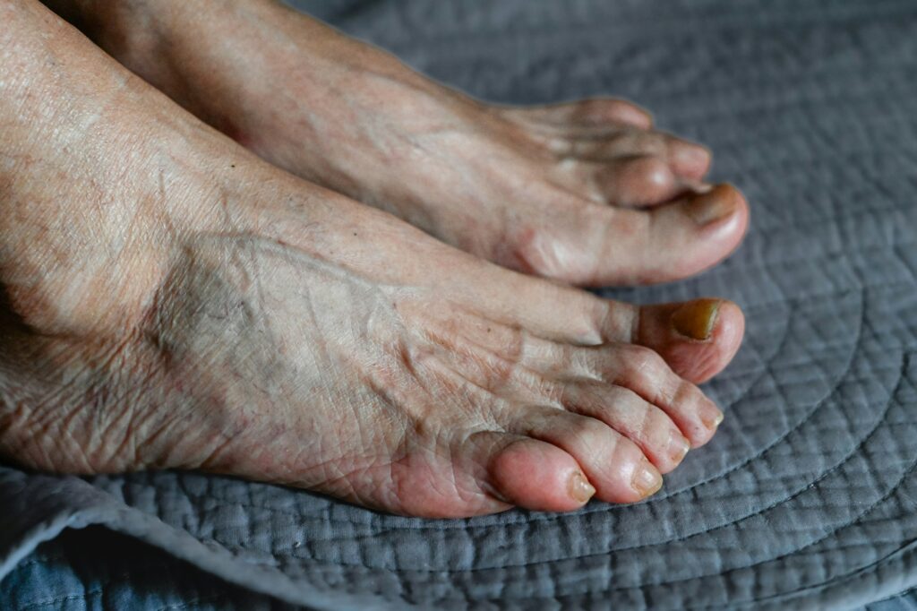 senior woman foot with medical condition, arthritis and fungus