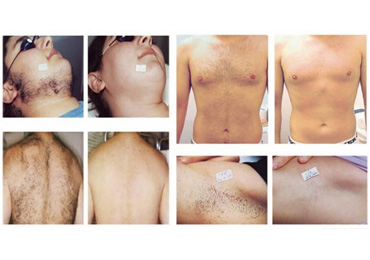 diode-laser-results